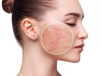 Young woman with couperose on face skin. mikrodermabrazja
